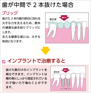 歯が中間で2本抜けた場合