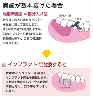 歯が数本抜けた場合