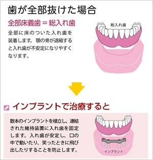 歯が全部抜けた場合